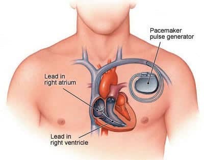 PACEMAKER IMPLANT