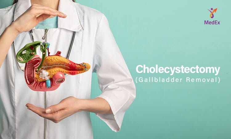 Cholecystectomy/ Gallbladder Removal - MedEx